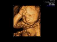 Imagen tridimensional de un feto de 23 semanas