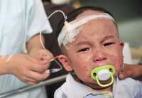 Wang Siyuan, de 2 años, es atendido en un hospital de la provincia china de Anhui, luego de resultar afectado de los huesos por consumir leche contaminada con melamina