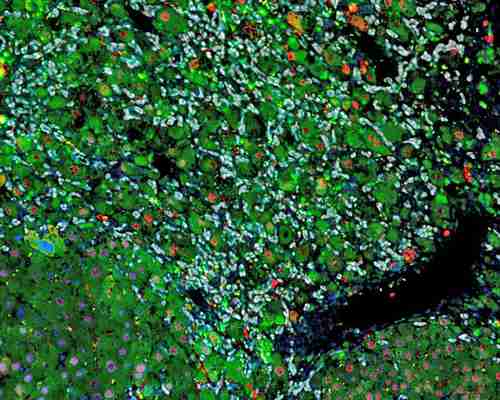 p En la gráfica, un órgano enfermo en el que distintos tipos de células han sido marcadas con fluoróforos que se distinguen con los colores blanco, verde y rojo. Foto Nabil Djouder/ CNIO