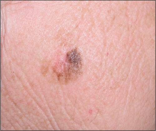 Melanoma Neglect Due to Covid Leads to Loss of Over 100 Thousand Years of Life in Europe