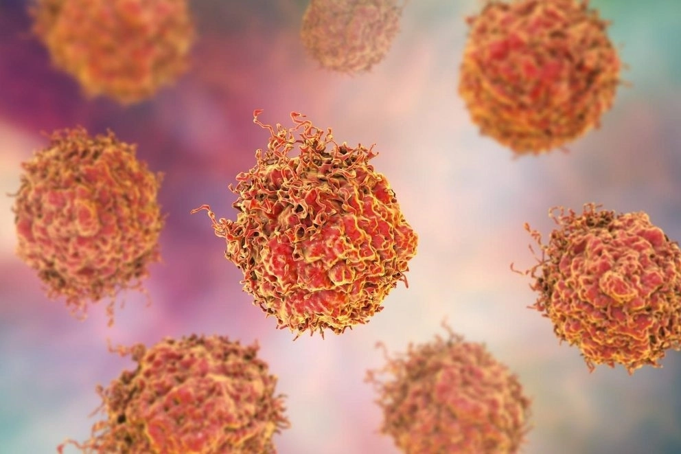 Células enfermas con cáncer de próstata. Foto Penn Medicine / Archivo
