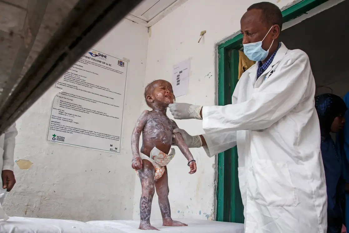 Un médico aplica crema a un niño con síntomas de desnutrición proteica severa que causa hinchazón y lesiones en la piel, en un centro de salud administrado por Acción contra el Hambre, en Mogadiscio, Somalia. Foto Ap