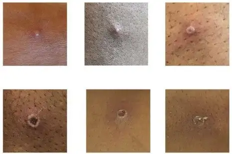 Después de sufrir síntomas como fiebre, dolor de cabeza y musculares, las personas infectadas presentan erupciones en la cara, las manos y los pies. Foto Agencia de Seguridad Sanitaria del Reino Unido vía Europa Press