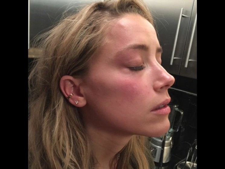 Imagen usada como evidencia de Amber Heard con marcas en su rostro que, según dice, fueron causadas por Johnny Depp, en mayo de 2016. Foto Tribunal Superior de Londres vía Ap
