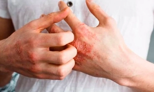 La PPG es una enfermedad cutánea rara, crónica y potencialmente mortal. Se caracteriza por brotes repentinos e intermitentes de pústulas dolorosas no contagiosas por todo el cuerpo cuya permanencia se mantiene por días o semanas. Imagen tomada del archivo de Gaceta UNAM 