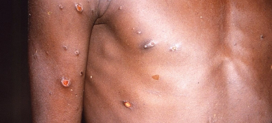 Brasil y México, con más casos de viruela símica en AL, según la OPS. Foto Europa Press / Archivo
