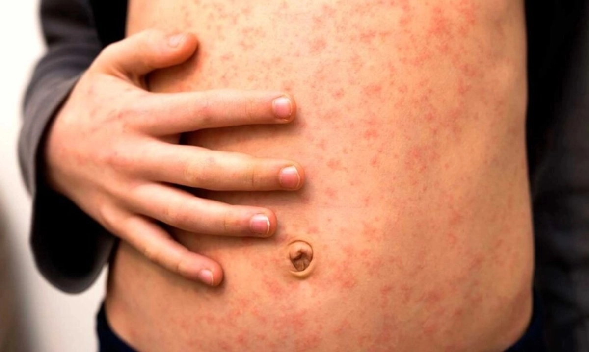 “Nunca ha sido fácil eliminar la transmisión endémica” del sarampión. América Latina lo logró ya en dos ocasiones y es factible hacerlo nuevamente, a diferencia de otras regiones que no lo han conseguido nunca: OPS 