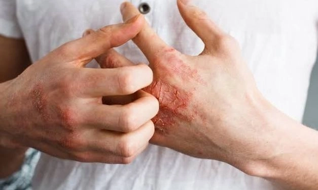 También se ha detectado “eritema pernio, alrededor de los dedos de la mano” y hay inflamación y dolor, pero “son lesiones benignas” que se resuelven conforme mejora el paciente con Covid-19. Foto tomada del sitio http://gaceta.facmed.unam.mx/index.php/2021/02/02/alteraciones-cutaneas-por-covid-19-y-por-el-uso-de-epp