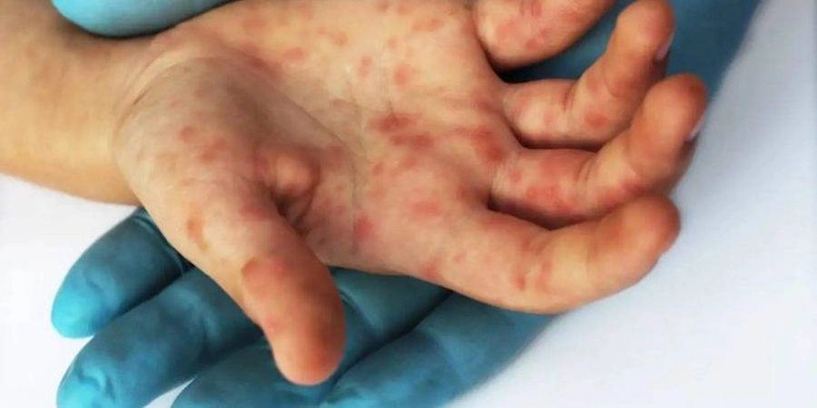 Jalisco ha confirmado un total de diez casos de viruela símica. Foto Afp / Archivo 