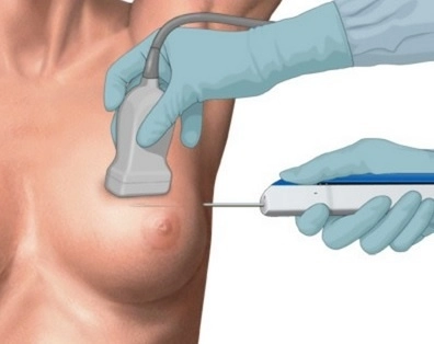 En mujeres mayores de 40 años, el primer método de detección es la mamografía, pero el ultrasonido como evaluación complementaria es fundamental. Foto cortesía