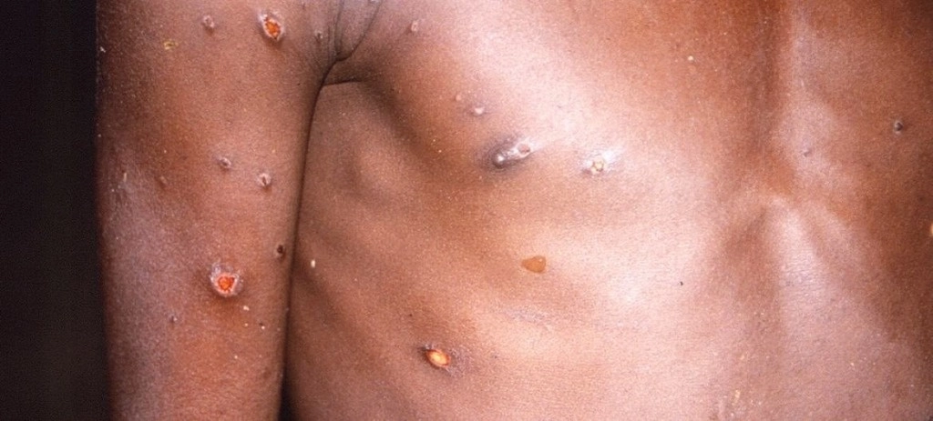 El mpox, o viruela del mono, produce lesiones cutáneas, fiebre y dolor corporal en las personas afectadas por el virus. Foto Europa Press   