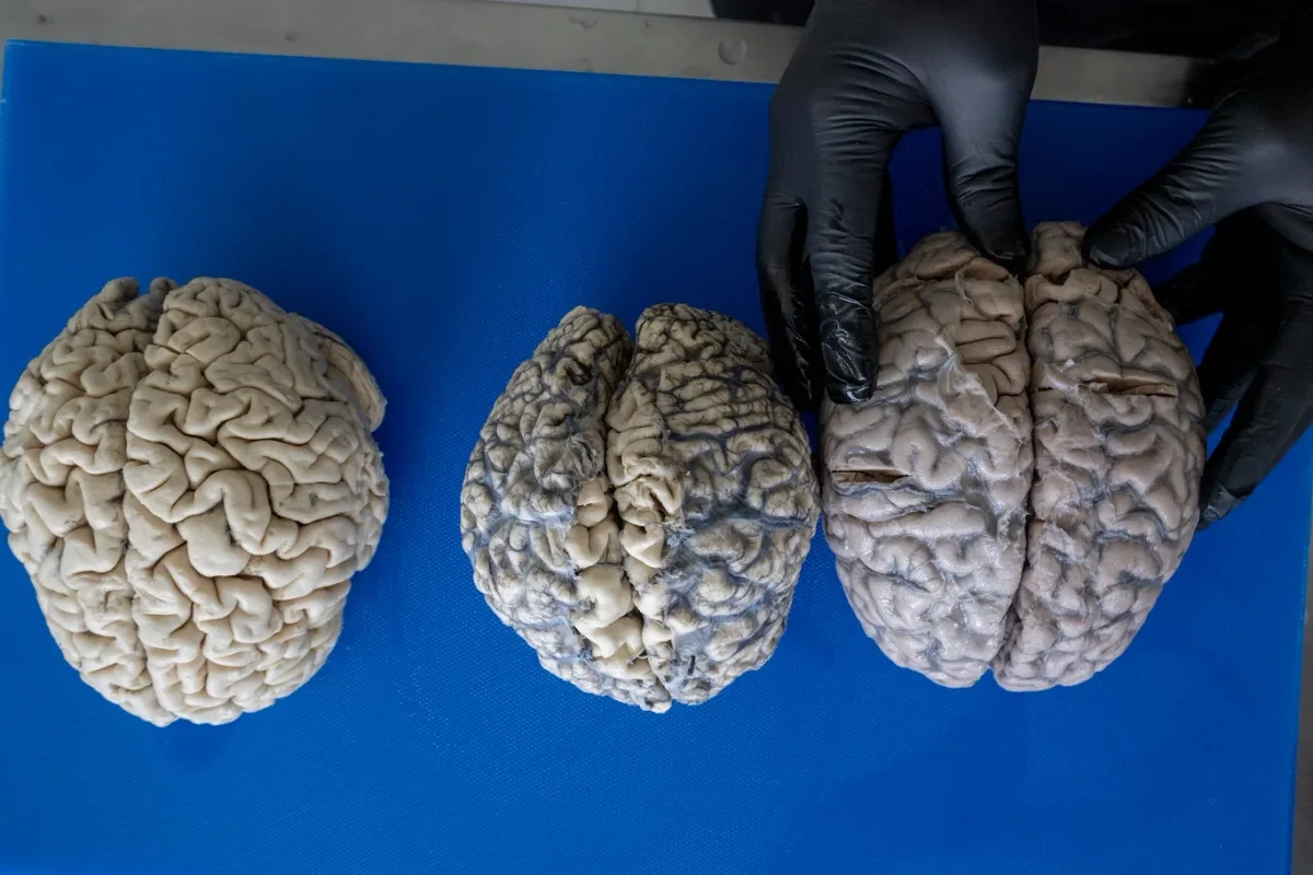 Tres cerebros humanos: uno con Alzheimer, otro con enfermedad de priones y uno más sin alteraciones. Foto 
