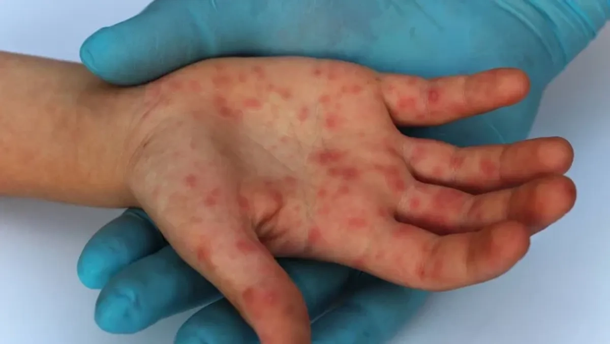 El paciente ingresó a los servicios públicos de salud por presentar sangrado de tubo digestivo bajo y “en ese momento se activó el protocolo de vigilancia epidemiológica. Foto