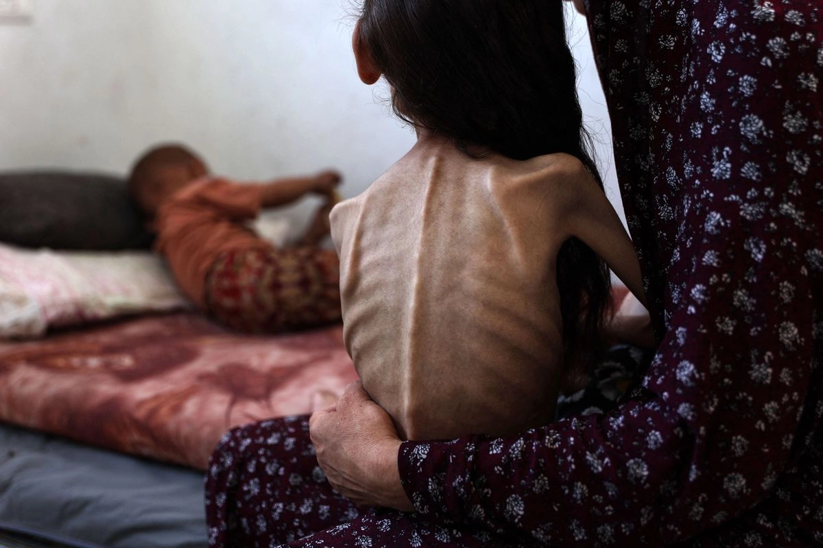 La niña palestina Mariam Dawwas, de nueve años, cuenta su madre, pesaba 25 kilos, pero bajó a sólo 10 debido a la escasez de alimentos por el bloqueo de ayuda decretado por Israel en Gaza. Foto 
