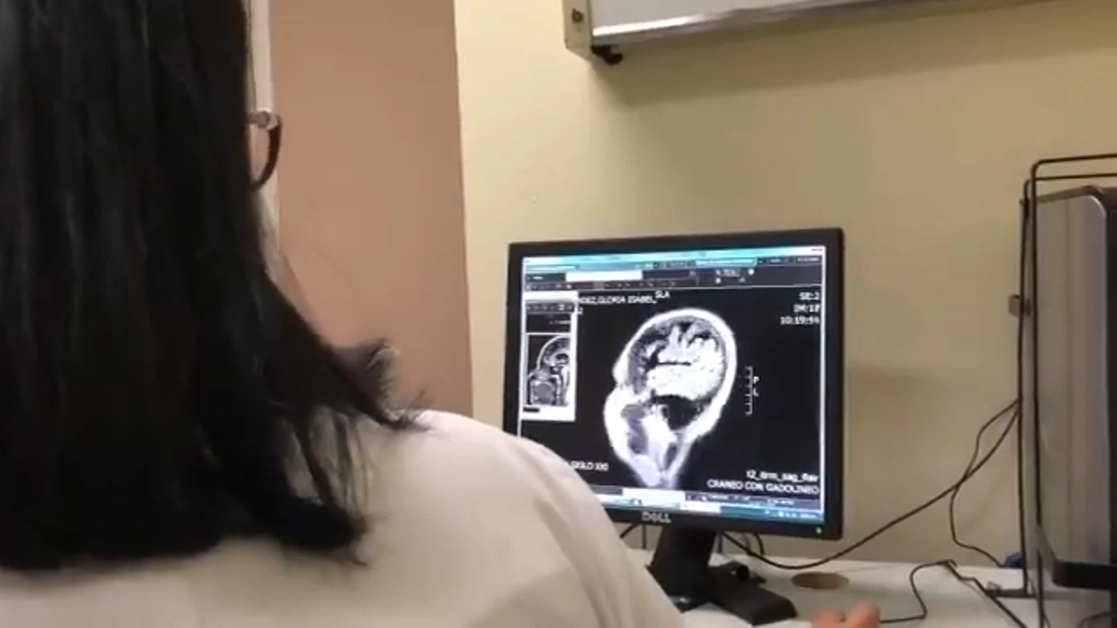 La EM afecta al sistema nervioso centra. Fotograma tomado del video emitido por el IMSS 