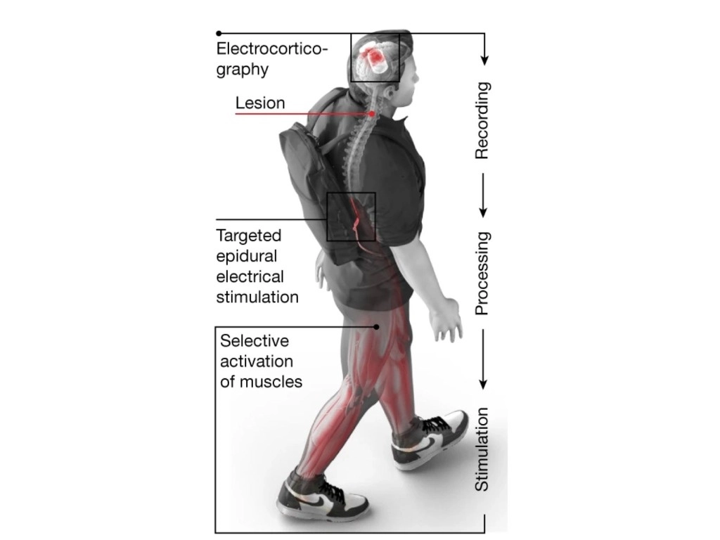 El equipo suizo que lideró el estudio, publicado en 'Nature Medicine', ya se había destacado previamente por sus avances en el uso de implantes cerebrales o medulares que permitieron a personas paralizadas volver a caminar. Imagen tomada de https://www.nature.com/articles/s41586-023-06094-5/figures/1
