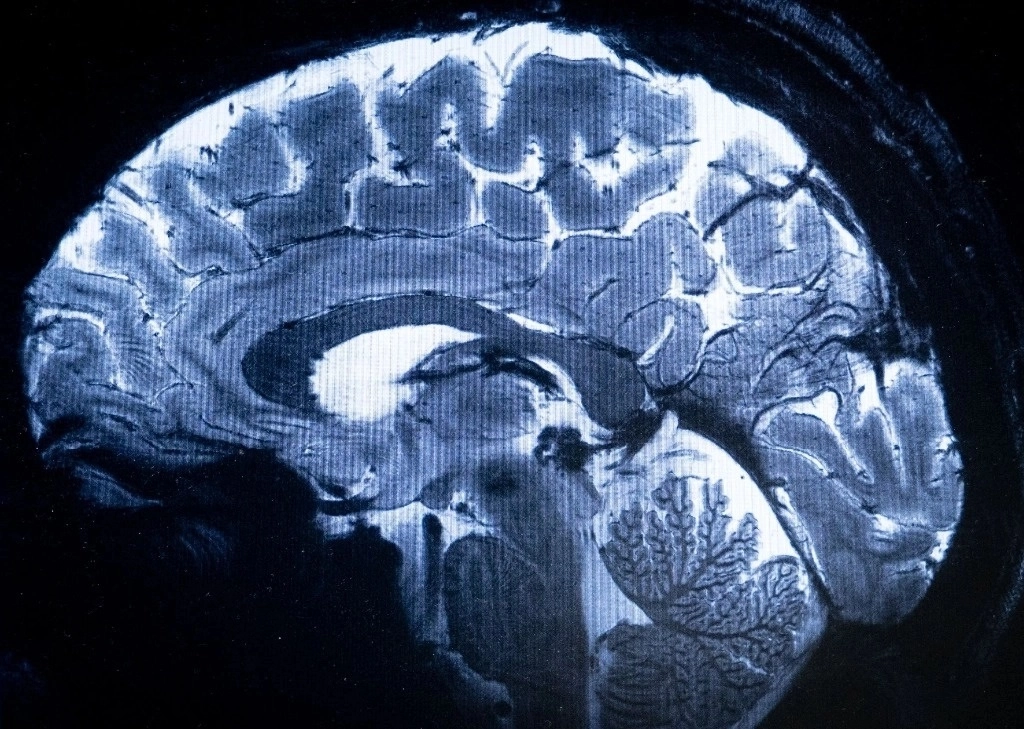 Los científicos utilizaron imágenes de resonancia magnética de los cerebros de los participantes para analizar patrones de enfermedades cardiovasculares y de otro tipo. Foto Afp