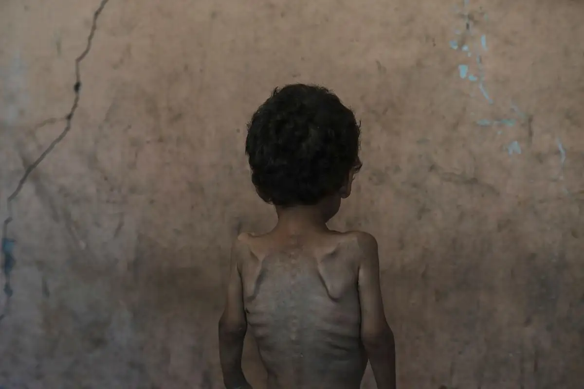 Yazan Abu Ful, un niño desnutrido de 2 años, en el campo de refugiados de Shati, en Gaza, el 23 de julio de 2025. Foto 
