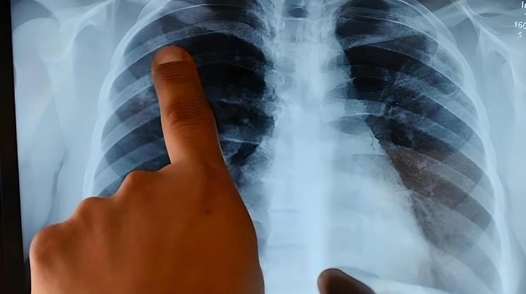 Especialista revisa una radiografía de tórax. Foto Afp / Archivo