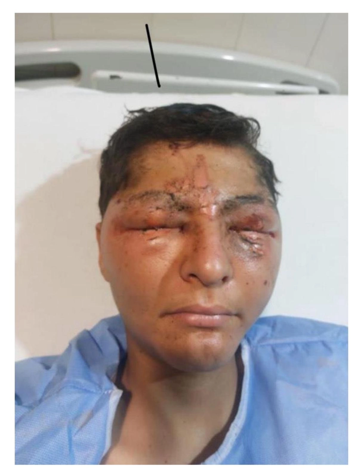El adolescente de 16 años ha quedado incapacitado de por vida tras la explosión en su rostro. Foto 