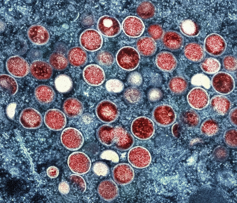 Esta imagen proporcionada por el Instituto Nacional de Alergias y Enfermedades Infecciosas (NIAID, por sus siglas en inglés) muestra una micrografía electrónica de transmisión coloreada de partículas Mpox (rojas) encontradas dentro de una célula infectada (azul). Foto Ap