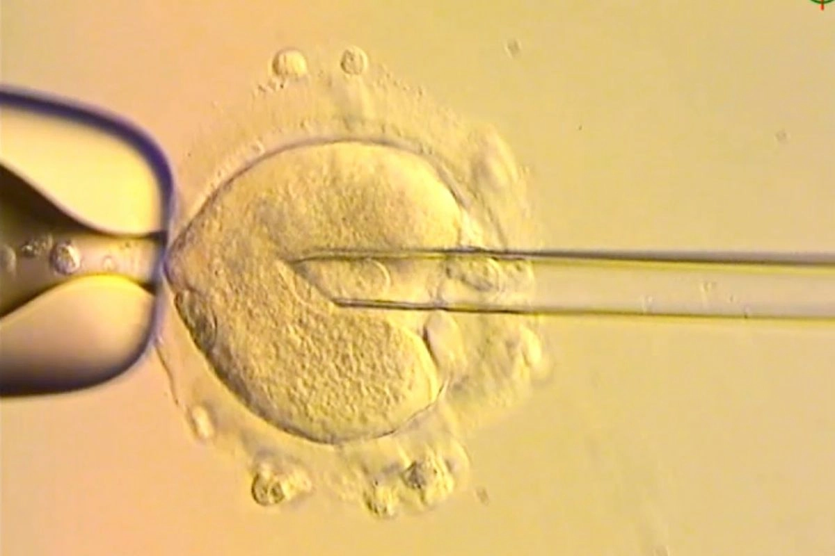 Inserción del genoma nuclear de un óvulo con una mutación en el ADN mitocondrial en un óvulo donado por una mujer sana. 
