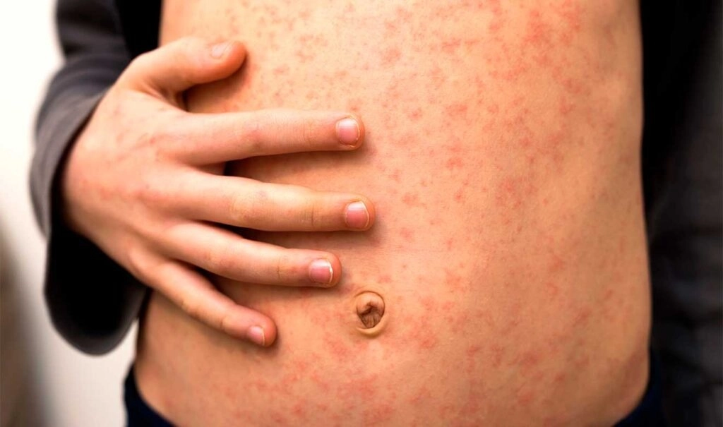 Se destacó la importancia de impulsar un esfuerzo colectivo en el que prácticamente la totalidad de las dependencias de salud “se suman a este esfuerzo, para garantizar la recuperación de las coberturas vacunales”. Imagen tomada de https://unamglobal.unam.mx/global_revista/el-sarampion-enciende-la-alerta-sanitaria/