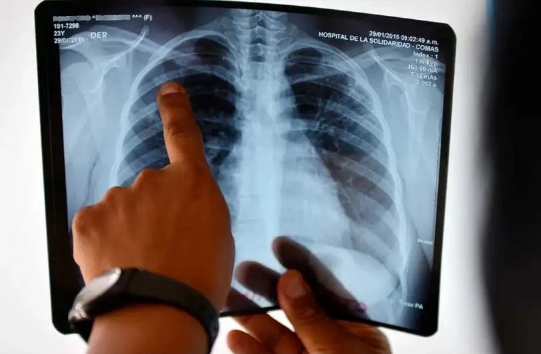 Especialista revisa una radiografía de tórax. Foto Afp / Archivo
