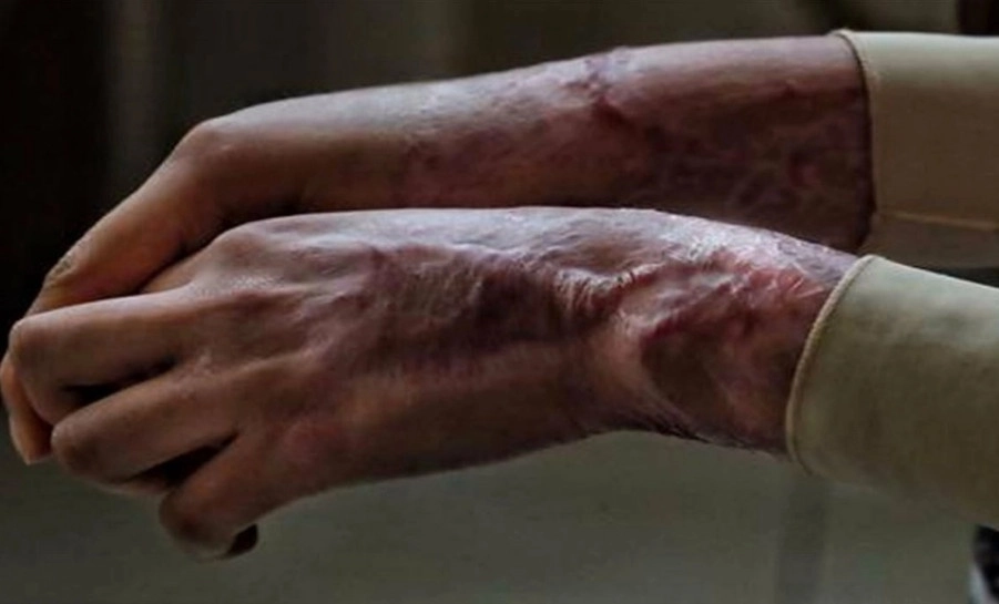 Morena propuso equiparar como tentativa de feminicidio los ataques contra mujeres con ácidos u otras sustancias corrosivas o líquidos a altas temperaturas, con una pena de hasta 30 años de prisión. Foto Marco Peláez / Archivo