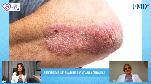 Rossana Llergo, presidenta de la Fundación Mexicana para la Dermatología, en videoconferencia. Imagen tomada de Facebook @fmdermatologia