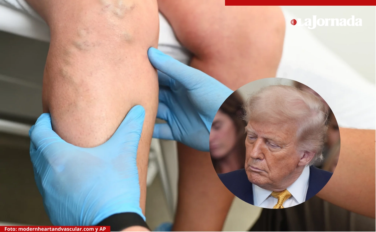 Trump fue diagnosticado con insuficiencia venosa crónica, una afección común en adultos mayores que afecta el retorno sanguíneo y puede causar hinchazón y hematomas en las extremidades.