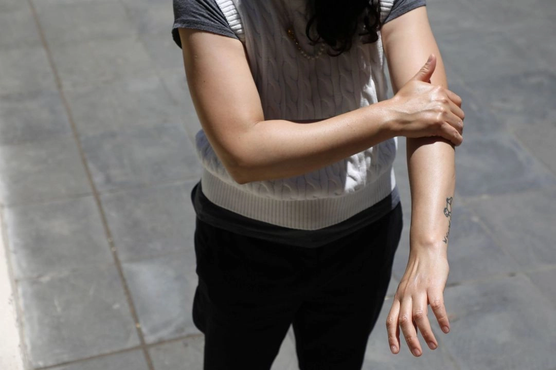 De casi 332 mil casos de melanoma cutáneo en el mundo en 2022, alrededor de 267 mil fueron causados por los rayos UV.