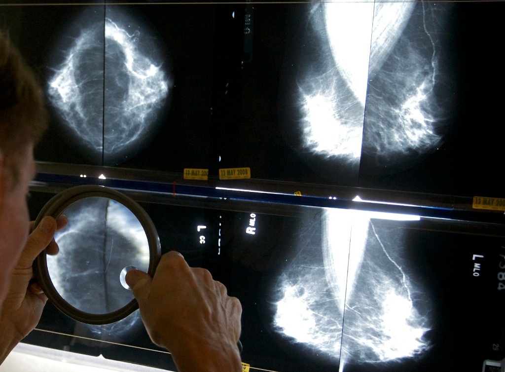 They recommend mammograms in the US from the age of 40