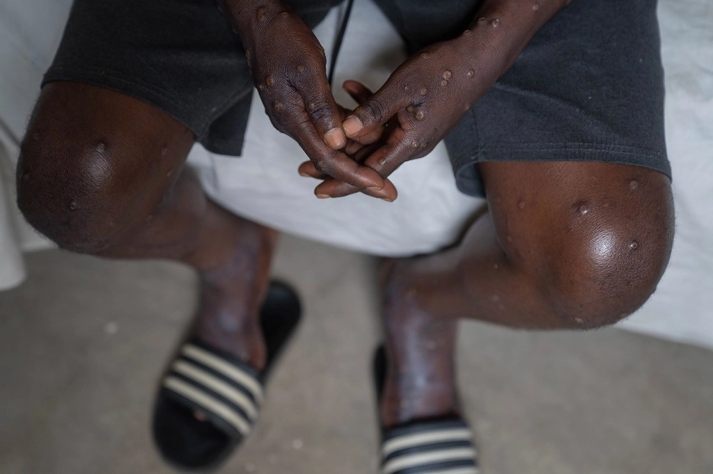 Un hombre contagiado de mpox en el Hospital General de Goma, en República Democrática del Congo. Foto Ap