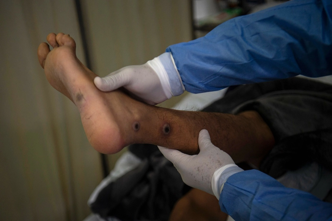Un médico revisa a un paciente con llagas causadas por una infección de viruela del mono, en un hospital en Lima, Perú. Foto Afp / Archivo