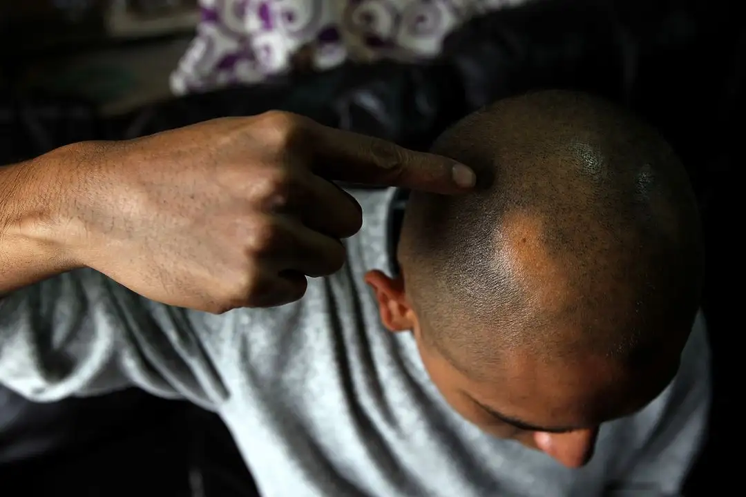 Un hombre muestra la pérdida de cabello. Foto