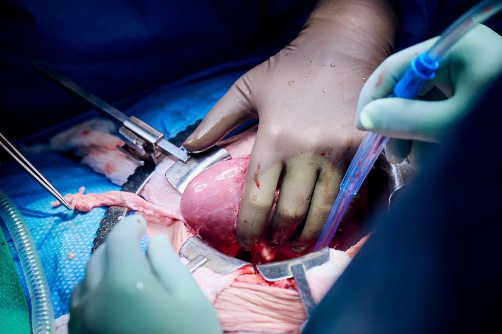 Pig kidney transplanted to woman on the brink of death
