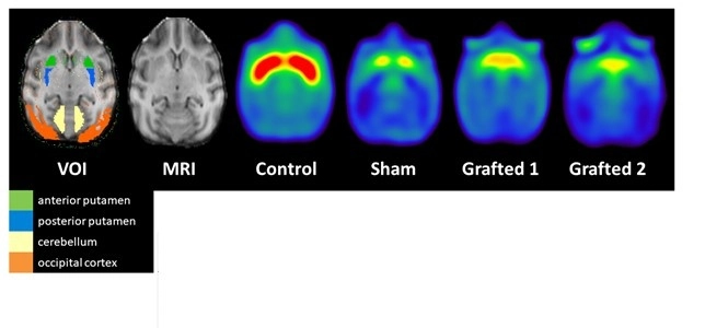 Láminas de inmunofluorescencia con la presencia de las neuronas trasplantadas 10 meses después de la operación. Foto cortesía de Aurelio Campos 