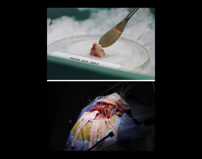 Pedazo de tejido cerebral vivo donado por paciente, quien, como se muestra en la imagen de abajo, fue sometida a una intervención para reducir las convulsiones. Foto Ap
