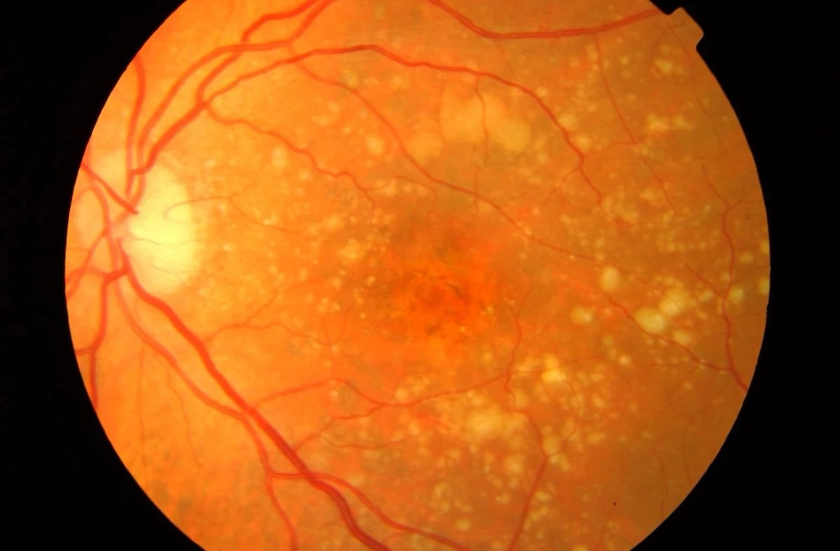 Imagen de una retina con degeneración macular asociada con la edad. 