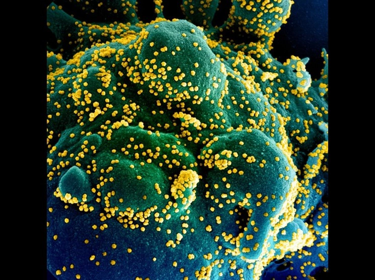 Una micrografía electrónica de exploración muestra una célula apoptótica coloreada (azul/verde) infectada con muchas partículas de virus SARS-CoV-2 (amarillas). La imagen fue capturada por el NIAID Integrated Research Facility (IRF) en Forot Detrick, Maryland. Foto Instituto Nacional de Alergias y Enfermedades Infecciosas / AFP