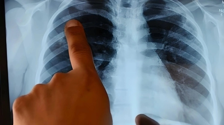 Especialista revisa una radiografía de tórax. Foto Afp / Archivo